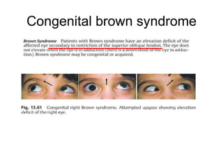 Congenital brown syndrome
 