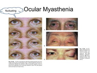 fluctuating   Ocular Myasthenia
 