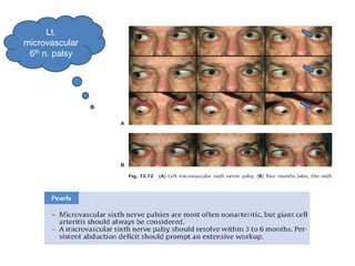 Lt.
microvascular
 6th n. palsy
 
