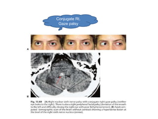Conjugate Rt.
 Gaze palsy
 