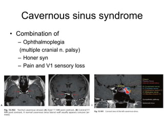 Cavernous sinus syndrome
• Combination of
  – Ophthalmoplegia
  (multiple cranial n. palsy)
  – Honer syn
  – Pain and V1 sensory loss
 