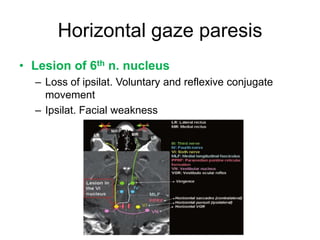 Horizontal gaze paresis
• Lesion of 6th n. nucleus
  – Loss of ipsilat. Voluntary and reflexive conjugate
    movement
  – Ipsilat. Facial weakness
 