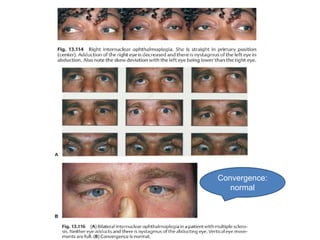 Convergence:
   normal
 