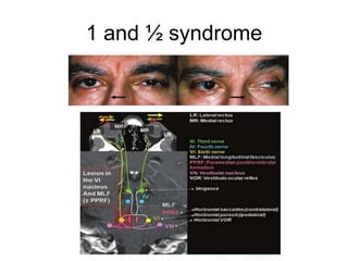 1 and ½ syndrome
 