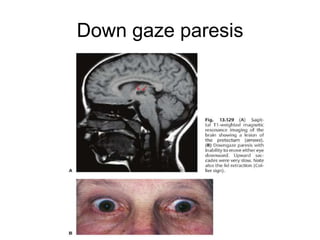 Down gaze paresis
 