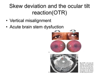 Skew deviation and the ocular tilt
         reaction(OTR)
• Vertical misalignment
• Acute brain stem dysfuction
 