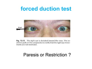 forced duction test




 Paresis or Restriction ?
 
