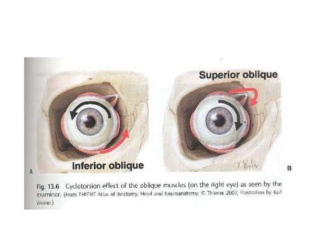 Binocular diplopia