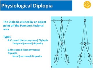 Physiological Diplopia
The Diplopia elicited by an object
point off the Pannum’s fusional
area
Types
A.Crossed (Heteronymous) Diplopia
Temporal (crossed) disparity
B.Uncrossed (homonymous)
Diplopia
Nasal (uncrossed) Disparity
 
