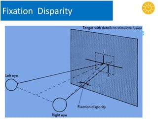 Fixation Disparity
It is the minute image displacement, rarely exceeding
several minutes of arc of angle, occurs within
Panum’s space while fusion is maintained.
• Due to presence of pannum’s fusional area
– A physiological variation in placement of retinal image
displacement from corresponding retinal points
• Even Allow fusion
• Displacement of retinal images in two eyes
– Retinal disparity
 