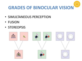 GRADES OF BINOCULAR VISION
• SIMULTANEOUS PERCEPTION
• FUSION
• STEREOPSIS
 