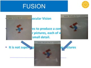 FUSION
• 2nd Grade of Binocular Vision
• Ability of the eyes to produce a composite picture
from two similar pictures, each of which is
incomplete in a small detail.
• It is not superimposition of dissimilar pictures
 