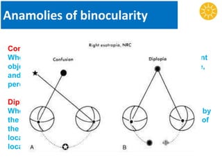 Anamolies of binocularity
Confusion
When squinting occurs the two foveas view two different
objects that are physically separated in objective space,
and send two different images to a single cortical
perceptual area. This leads to confusion.
Diplopia
When squinting occurs an object in space is perceived by
the fovea of one eye and some other extra-foveal point of
the other eye, which has a different projection or
localization value in space. Thus an object would be
localized twice in space causing diplopia.
 