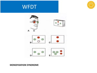 WFDT
MONOFIXATION SYNDROME
 