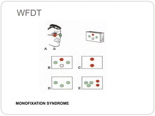 WFDT
MONOFIXATION SYNDROME
 