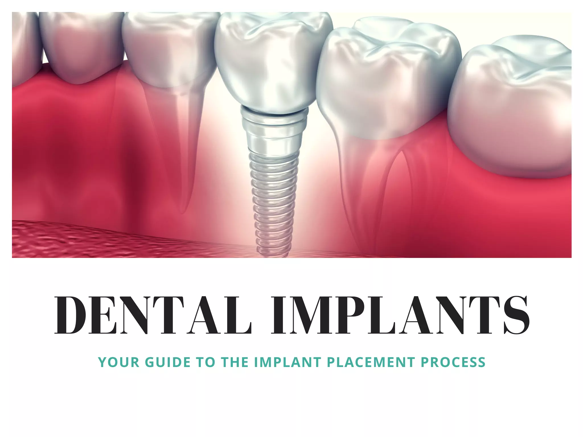 Dental Implants: Your Guide to the Implant Placement Process | PDF