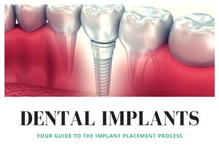 DENTAL IMPLANTS
YOUR GUIDE TO THE IMPLANT PLACEMENT PROCESS
 