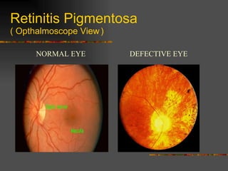 Retinitis Pigmentosa ( Opthalmoscope View   ) NORMAL EYE DEFECTIVE EYE 
