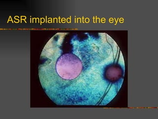 ASR implanted into the eye 