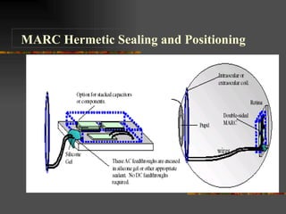 MARC Hermetic Sealing and Positioning 