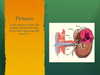 Pictures
 In this picture it shows the
  kidney and then the huge
tumor that is growing right
           next to it.
 