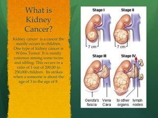 What is
      Kidney
      Cancer?
Kidney cancer is a cancer the
  mostly occurs in children.
One type of kidney cancer is
  Wilms Tumor. It is mostly
common among some twins
and sibling. This occurs in a
  ratio of 1 out of 200,00 to
 250,000 children. Its strikes
when a someone is about the
   age of 3 to the age of 8.
 