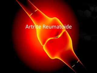 Artrite Reumatoide
 