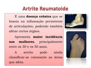 É uma doença crónica que se
baseia na inflamação persistente
de articulações, podendo também
afetar certos órgãos.
      Apresenta maior incidência
nas       mulheres,   principalmente
entre os 30 e os 50 anos.
      A     artrite   pode    ainda
classificar-se consoante as áreas
que afeta.
 