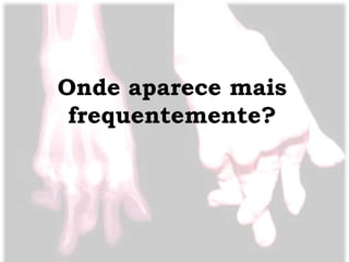 Onde aparece mais
 frequentemente?
 