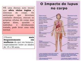 É uma doença auto imune
que afeta vários órgãos e
sistemas     do     corpo.   Os
anticorpos      que    deveriam
combater doenças, atacam as
próprias células do corpo mas
apesar    disso,     quando   o
indivíduo     é     devidamente
tratado, pode levar uma vida
normal.


Ocorre                  mais
frequentemente            em
mulheres do que em homens,
especialmente entre as idades
de 15 e 50 anos.
 