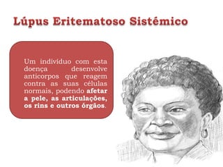 Um indivíduo com esta
doença        desenvolve
anticorpos que reagem
contra as suas células
normais, podendo afetar
a pele, as articulações,
os rins e outros órgãos.
 