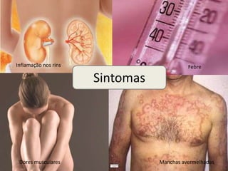 Inflamação nos rins                        Febre

                      Sintomas




 Dores musculares                Manchas avermelhadas
 