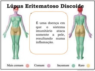Lúpus Eritematoso Discoide


         É uma doença em
         que    o  sistema
         imunitário ataca
         somente a pele,
         resultando numa
         inflamação.
 