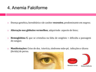 4. Anemia Falciforme 
 Doença genética, hereditária e de caráter recessivo, predominante em negros; 
 Alteração nos glóbulos vermelhos, adquirindo aspecto de foice; 
 Hemoglobina S, que se cristaliza na falta de oxigênio = dificulta a passagem 
do sangue; 
 Manifestações: Crise de dor, icterícia, síndrome mão-pé, infecções e úlcera 
(ferida) de perna. 
 