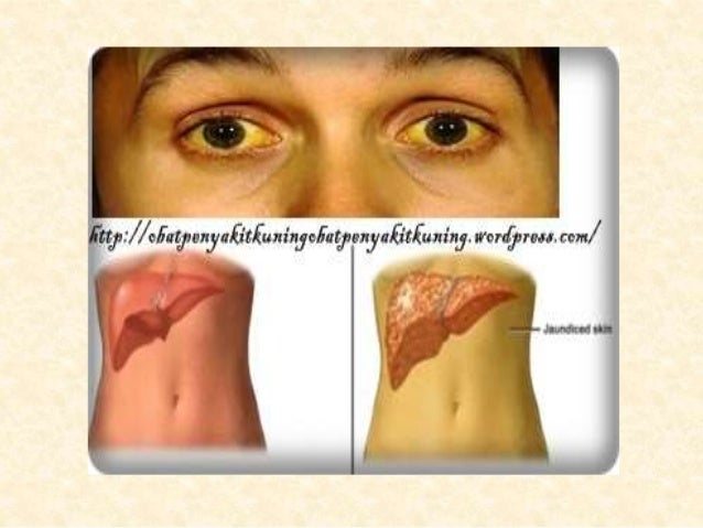 Gangguan Pada Sistem Eksresi Manusia