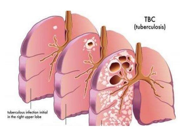 Gangguan Pada Sistem Eksresi Manusia