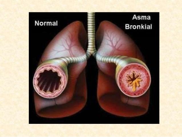 Gangguan Pada Sistem Eksresi Manusia