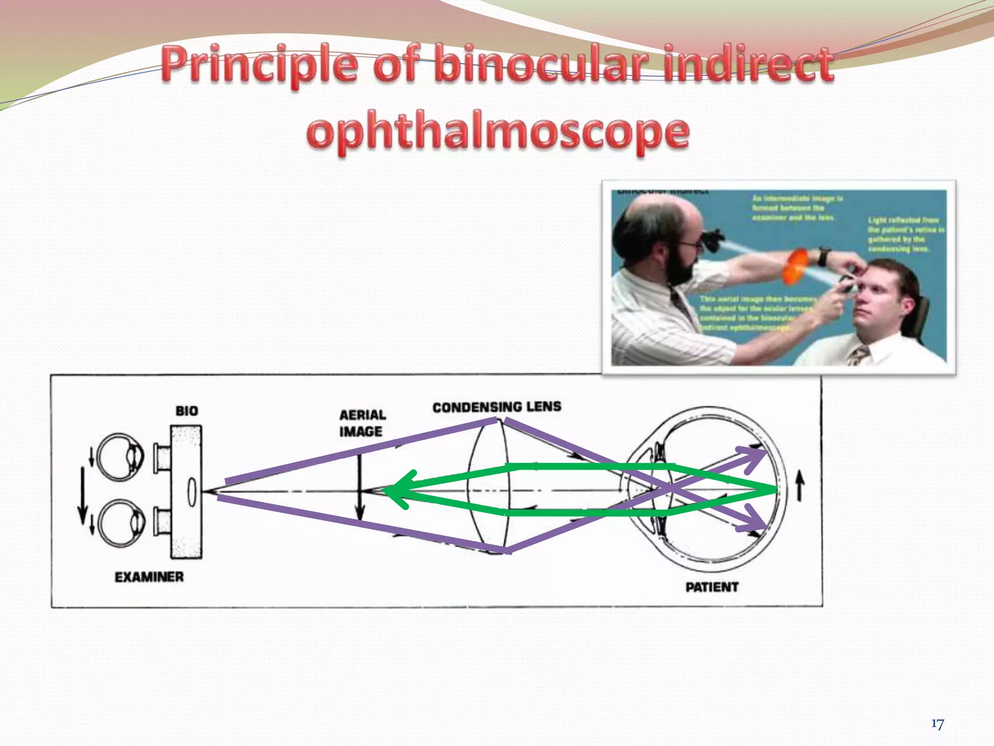 Binocular Indirect OPHTHALMOSCOPY