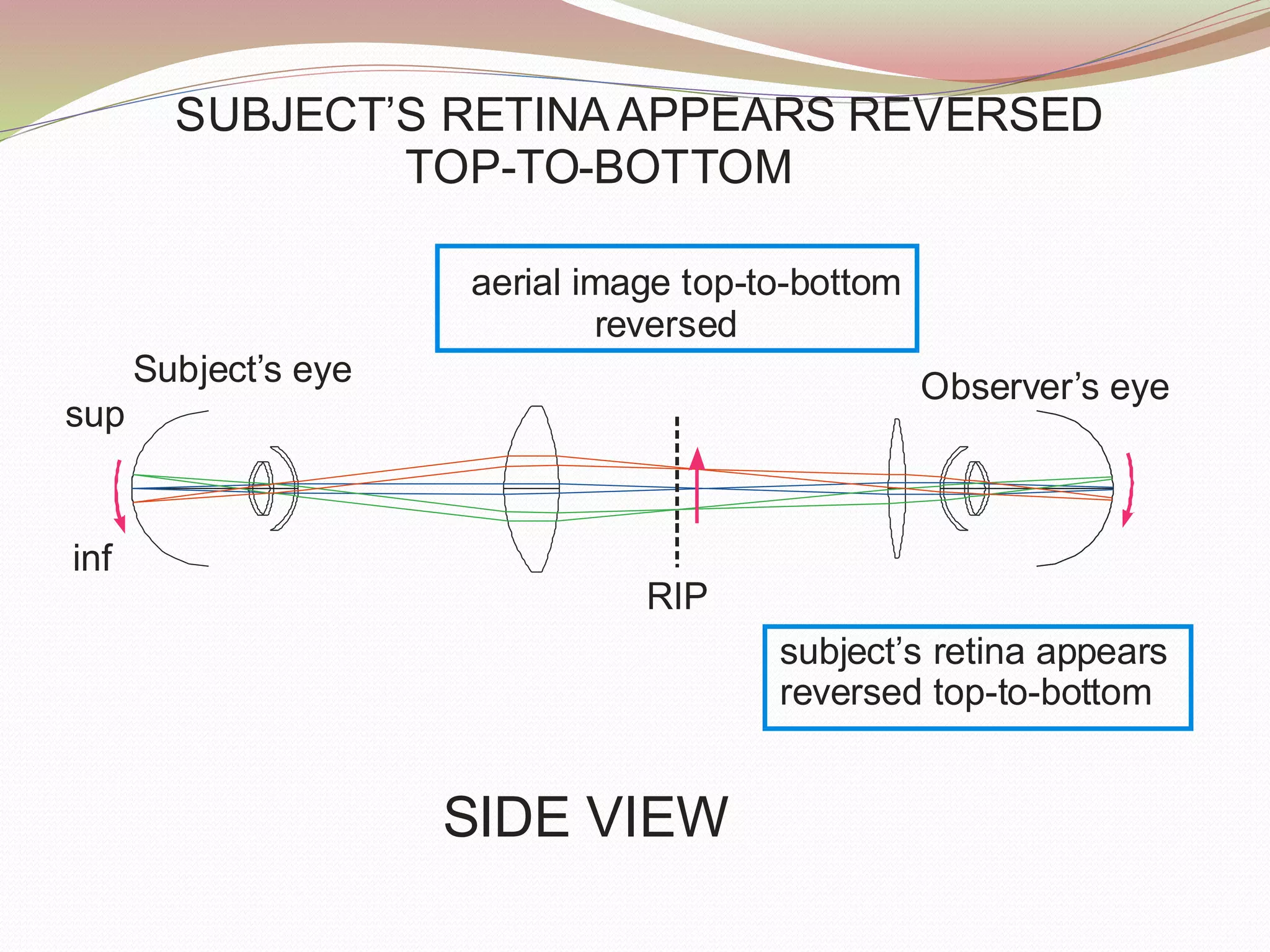 Binocular Indirect OPHTHALMOSCOPY