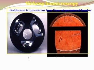 Slitlamp biomicroscopy
Goldmann triple-mirror lens
• Image is upside down
View of peripheral fundus
 
