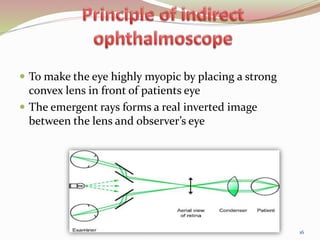  To make the eye highly myopic by placing a strong
convex lens in front of patients eye
 The emergent rays forms a real inverted image
between the lens and observer’s eye
16
 