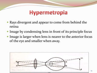  Rays divergent and appear to come from behind the
retina
 Image by condensing lens in front of its principle focus
 Image is larger when lens is nearer to the anterior focus
of the eye and smaller when away.
23
 