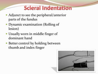  Adjunct to see the peripheral/anterior
parts of the fundus
 Dynamic examination (Rolling of
lesion)
 Usually worn in middle finger of
dominant hand
 Better control by holding between
thumb and index finger
47
 