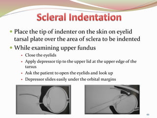  Place the tip of indenter on the skin on eyelid
tarsal plate over the area of sclera to be indented
 While examining upper fundus
 Close the eyelids
 Apply depressor tip to the upper lid at the upper edge of the
tarsus
 Ask the patient to open the eyelids and look up
 Depressor slides easily under the orbital margins
49
 