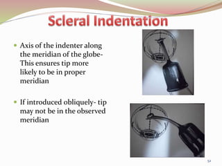  Axis of the indenter along
the meridian of the globe-
This ensures tip more
likely to be in proper
meridian
 If introduced obliquely- tip
may not be in the observed
meridian
52
 
