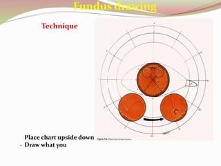 Fundus drawing
• Place chart upside down
• Draw what you see
Technique
 