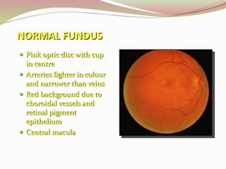 NORMAL FUNDUS
 Pink optic disc with cup
in centre
 Arteries lighter in colour
and narrower than veins
 Red background due to
choroidal vessels and
retinal pigment
epithelium
 Central macula
 