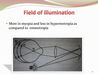  More in myopia and less in hypermetropia as
compared to emmetropia
19
 