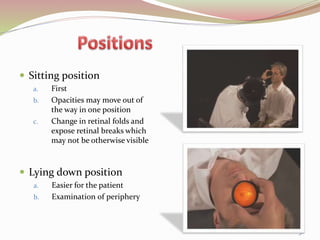  Sitting position
a. First
b. Opacities may move out of
the way in one position
c. Change in retinal folds and
expose retinal breaks which
may not be otherwise visible
 Lying down position
a. Easier for the patient
b. Examination of periphery
30
 