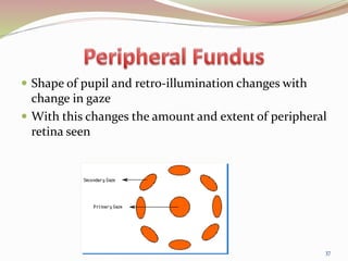  Shape of pupil and retro-illumination changes with
change in gaze
 With this changes the amount and extent of peripheral
retina seen
37
 
